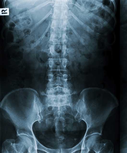 Xray of spine